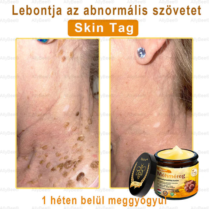Spzv® bőrkezelő krém öregedésgátló, hidratáló, bőrjavító, egyenletes tónus, pattanások és sötét foltok kezelése, szemölcs és anyajegy eltávolítása, pikkelysömör enyhítése