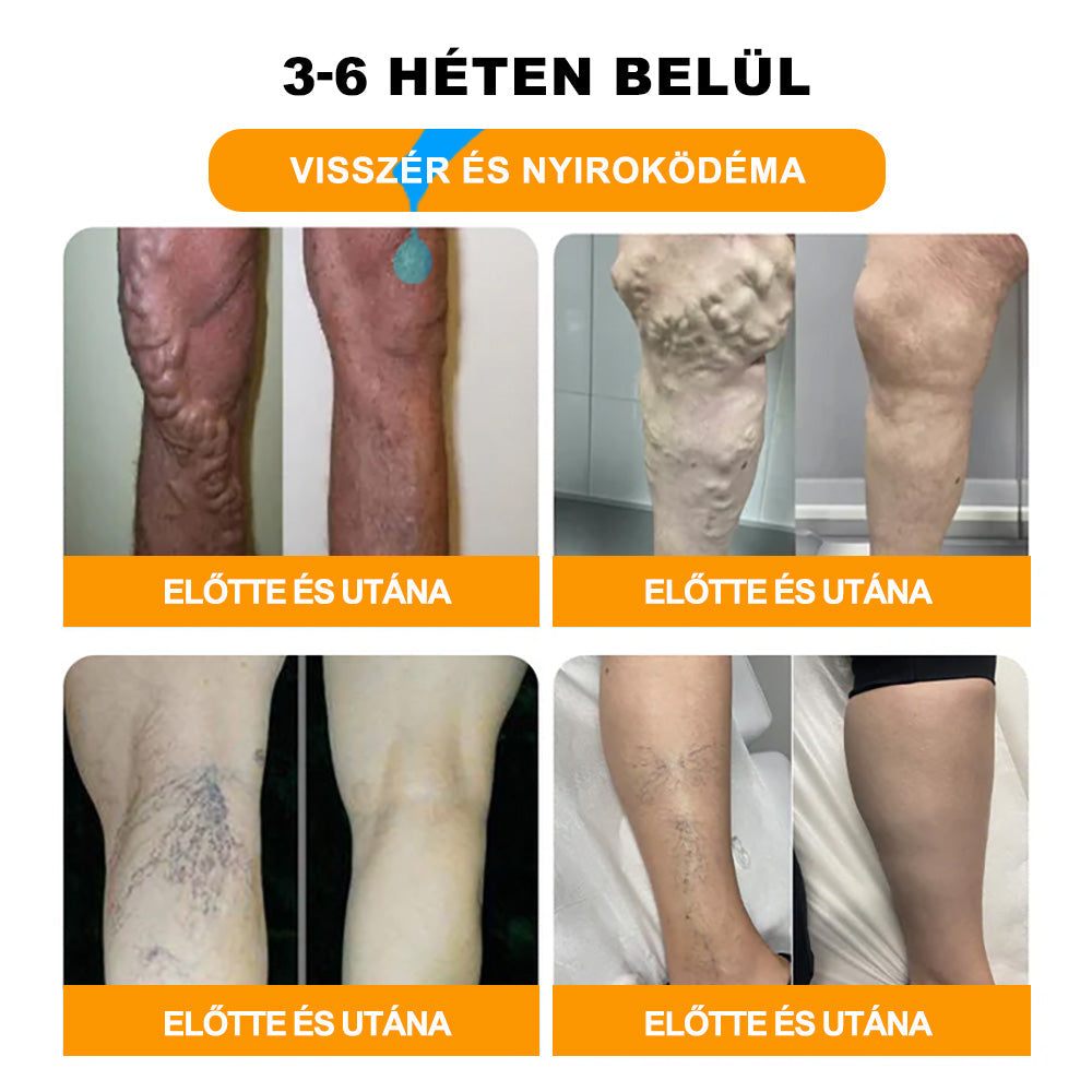 🚚📦Utolsó nap, hogy 70% KI: Tnnedey® 𝑴é𝒉𝒎é𝒓𝒆𝒈 é𝒔 30 𝒈𝒚ó𝒈𝒚𝒏ö𝒗é𝒏𝒚 𝒅𝒆𝒕𝒐𝒙 𝒍á𝒃𝒇ü𝒓𝒅ő 𝒈𝒚ö𝒏𝒈𝒚ö𝒌 𝒂 𝒕𝒆𝒔𝒕𝒇𝒐𝒓𝒎á𝒍á𝒔𝒉𝒐𝒛- Az Amerikai Nyirokgyógyászati Akadémia (ALA) ajánlása.