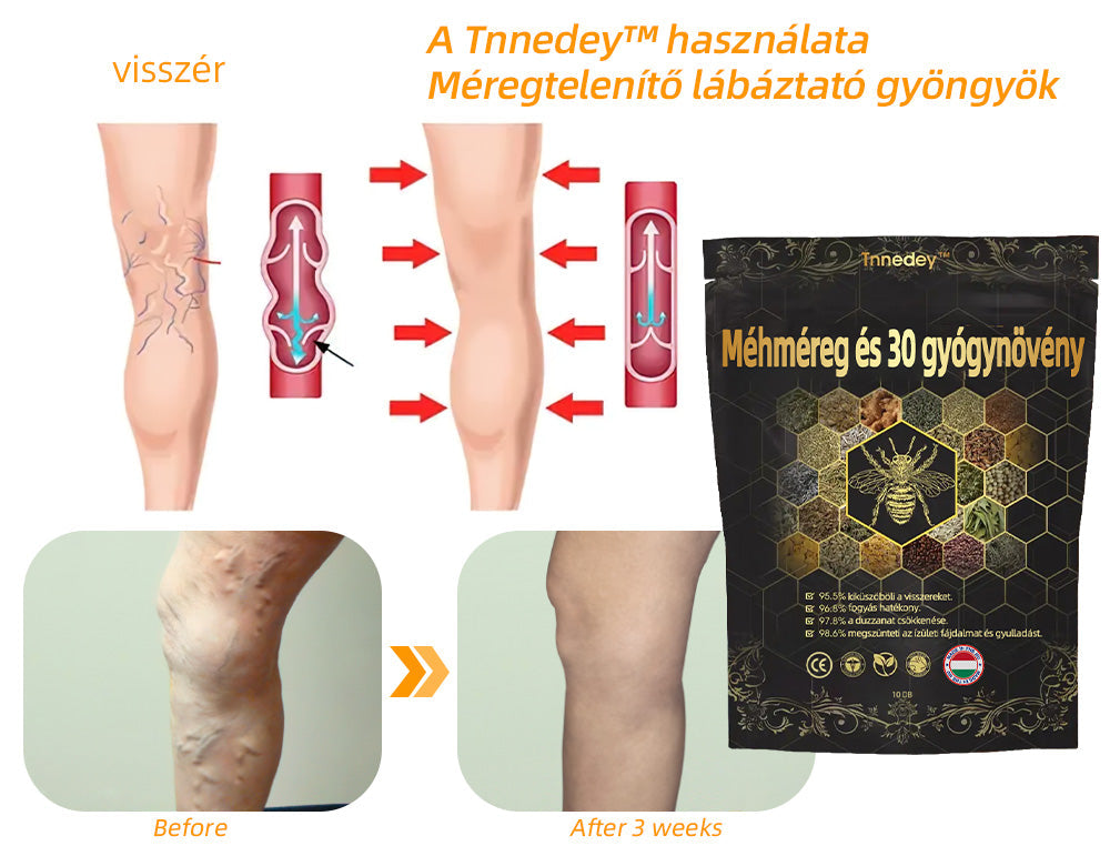 🚚📦Utolsó nap, hogy 70% KI: Tnnedey® 𝑴é𝒉𝒎é𝒓𝒆𝒈 é𝒔 30 𝒈𝒚ó𝒈𝒚𝒏ö𝒗é𝒏𝒚 𝒅𝒆𝒕𝒐𝒙 𝒍á𝒃𝒇ü𝒓𝒅ő 𝒈𝒚ö𝒏𝒈𝒚ö𝒌 𝒂 𝒕𝒆𝒔𝒕𝒇𝒐𝒓𝒎á𝒍á𝒔𝒉𝒐𝒛- Az Amerikai Nyirokgyógyászati Akadémia (ALA) ajánlása.